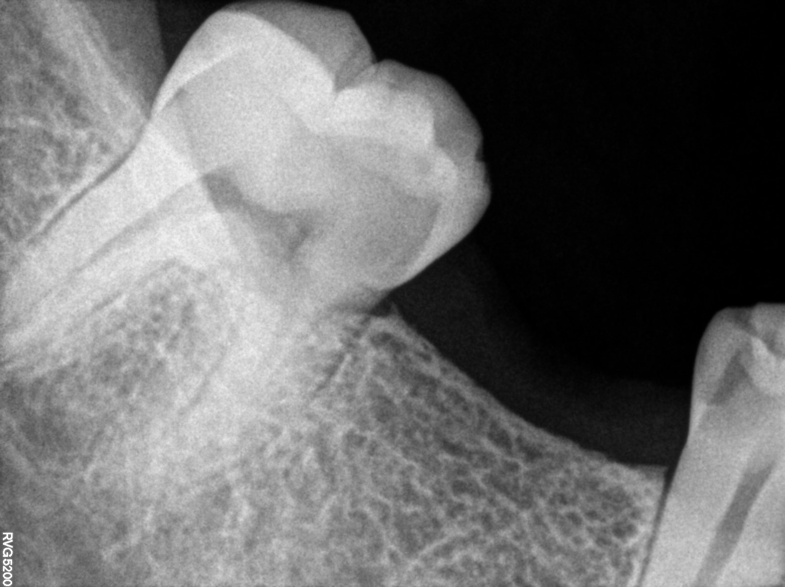 Dental X-ray